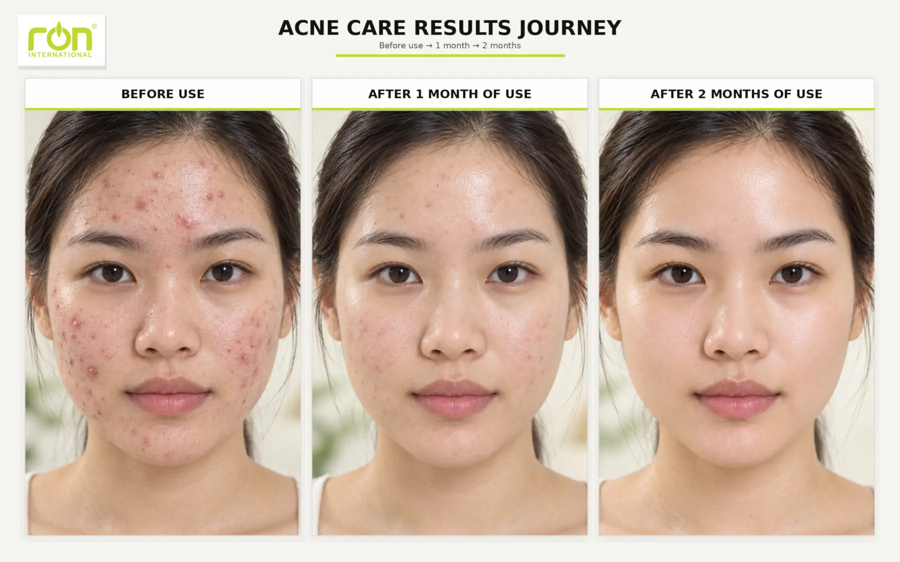 Hình minh họa ba giai đoạn trong hành trình chăm sóc da dễ nổi mụn